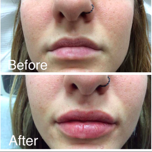 Explore ballerina tattoos ideas, creative tattoo ideas in Lake Oswego, available at Lake Oswego Vein and Aesthetic LOVA