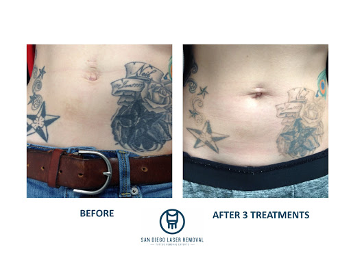 Explore red tattoo cover up ideas, creative tattoo ideas in San Diego, available at Removery Tattoo Removal & Fading