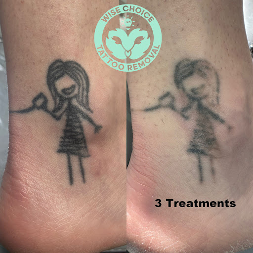 Explore honor tattoo ideas, creative tattoo ideas in Denver, available at Wise Choice Tattoo Removal