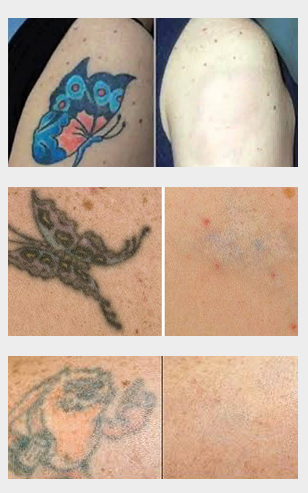 Yorkshire Laser Tattoo Removal