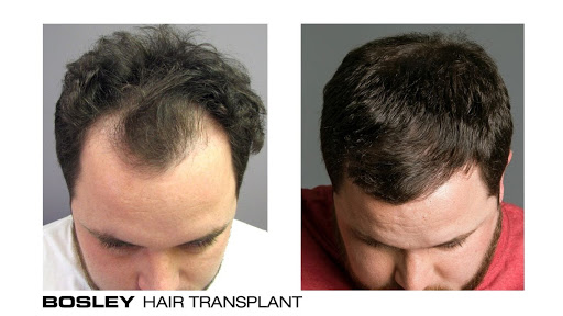 Bosley - Hair Restoration & Transplant