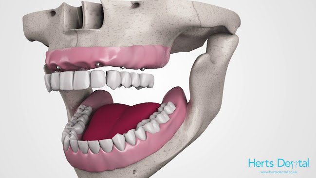 Reviews of Herts Dental Watford Implant Dentist in Watford - Dentist