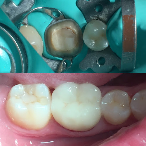 Dentist Crangasi Bucuresti Remis Constantin - Implant Dentar - Fast And Fixed Proteza Fixa - <nil>