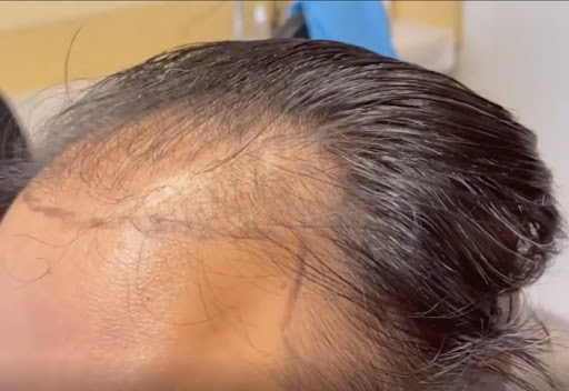 Ziering Medical Hair Restoration Beverly Hills image
