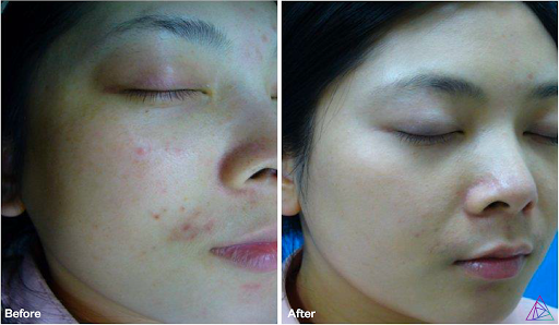 Explore aquarius tattoo ideas male, creative tattoo ideas in Glenwood Springs, available at Lifestyle Laser