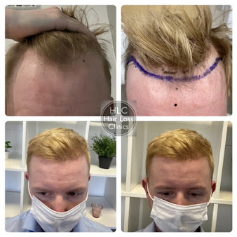 عيادات تساقط الشعر - كارلايل - The Hair Loss Clinics - Carlisle