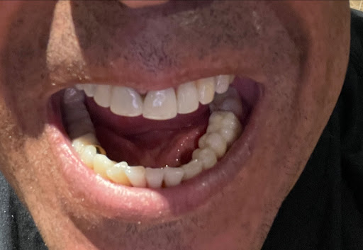 Clínica Dental Romero - Dentista – Obturaciones – Prótesis Fijas – Zirconio – Clínica – Dental – Romero – Anestesia – Bucal – Cálculo – Canal - Caries