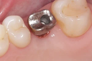 Implante Dentário | Lente de contato dental | Dentista | Drummond Odontologia | Montenegro-RS image