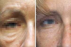 Microneedling Miami Center image