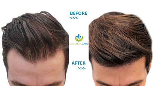 Colombia Care Hair Transplant