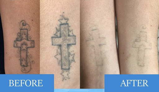 Explore fleetwood mac tattoo ideas, creative tattoo ideas in San Antonio, available at South West Tattoo Removal Program