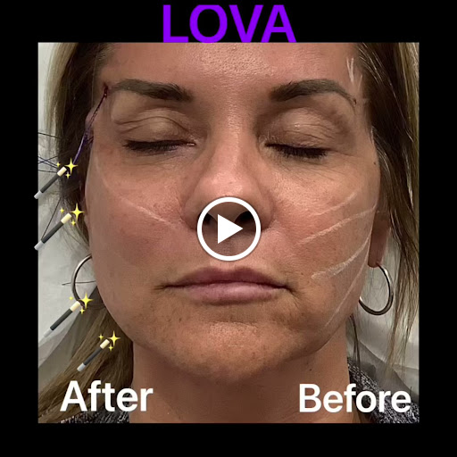 Explore kintsugi tattoo ideas, creative tattoo ideas in Lake Oswego, available at Lake Oswego Vein and Aesthetic LOVA