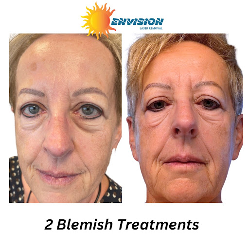 Explore fire and ice tattoo ideas, creative tattoo ideas in Port Charlotte, available at Envision Laser Removal