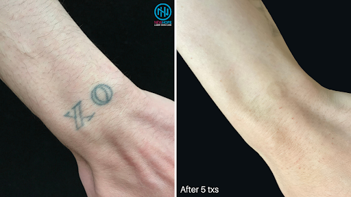 Explore mexican tattoo ideas for guys, creative tattoo ideas in Westminster, available at Newhope Laser Skin Care