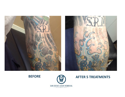 Explore emo anime tattoo ideas, creative tattoo ideas in San Diego, available at Removery Tattoo Removal & Fading