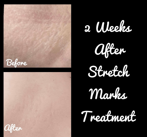 Explore fishing hook tattoo ideas, creative tattoo ideas in Ballwin, available at Lumiere Laser Studio