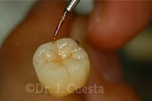 Implantologia Estética Dr. J. Cuesta image