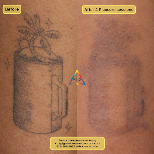 Explore duran duran tattoo ideas, creative tattoo ideas in New York, available at Ag2g Laser Tattoo Removal & MedSpa