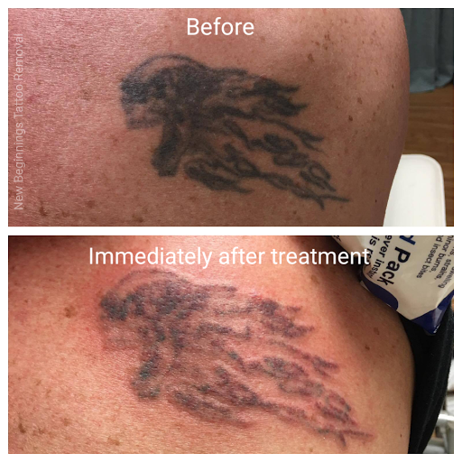 Explore hand tattoo ideas for woman, creative tattoo ideas in Arvada, available at New Beginnings Tattoo Removal