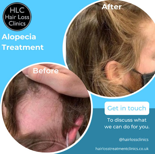 The Stockport Hair Loss Clinic - The Stockport Hair Loss Clinic