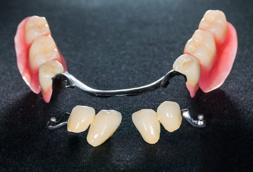 Denture Implants Albany image 4