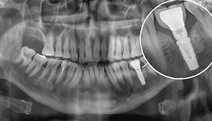 Implantes Dentales Salamanca,Gto // IMPLANTOLOGIA ESPECIALIZADA