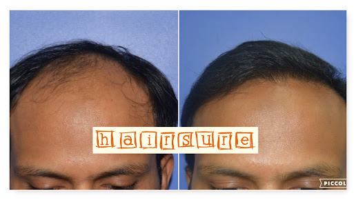 HairSure Hair Transplant center - HairSure Hair Transplant center