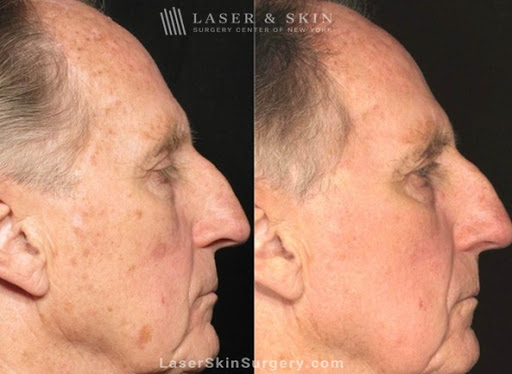 Explore two face tattoo ideas, creative tattoo ideas in Southampton, available at Laser & Skin Surgery Center of New York - Southampton