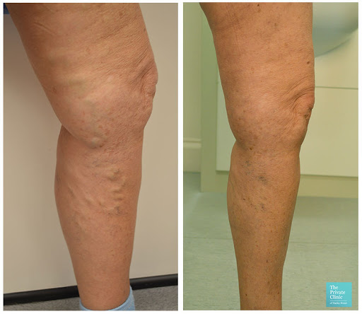 The Private Clinic -Varicose Veins