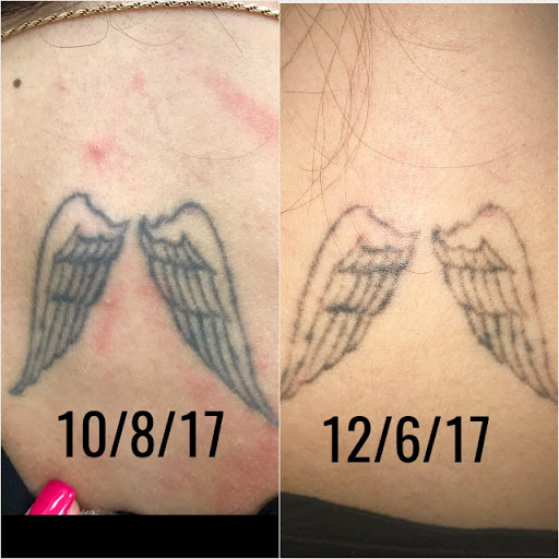 Explore arm tattoo ideas for women, creative tattoo ideas in Middle Village, available at Bye Bye Ink Laser Tattoo Removal