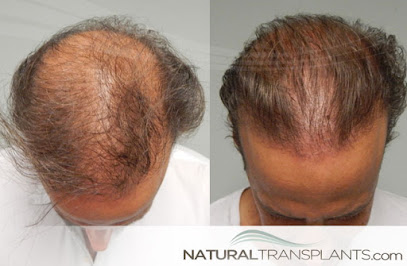 Natural Transplants, Hair Restoration Clinic