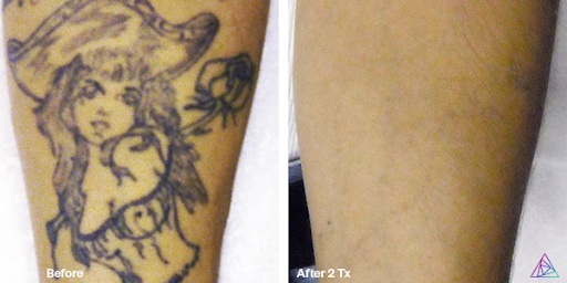 Explore radiology tattoo ideas, creative tattoo ideas in Rowlett, available at Bonsai Laser Tattoo Removal