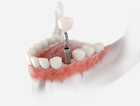Denture Repair and Implants