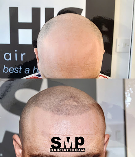 SMP® Scalp Micropigmentation Mississauga | HAIRTATTOO.CA