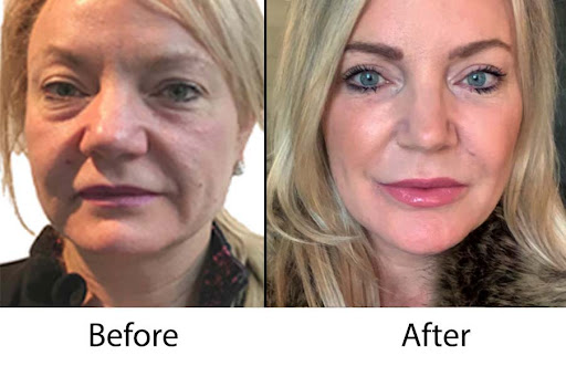 Explore juice wrld tattoo ideas, creative tattoo ideas in Sterling Heights, available at Skin & Vein Center