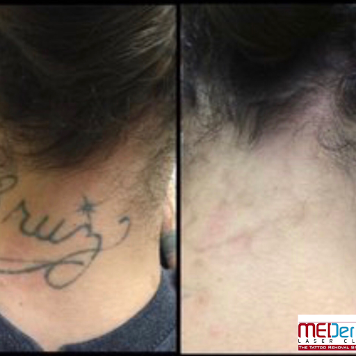 Explore pooh bear tattoo ideas, creative tattoo ideas in San Antonio, available at MEDermis Tattoo Removal