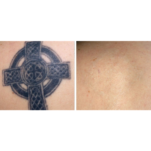 Explore bring me the horizon tattoo ideas, creative tattoo ideas in Tucson, available at Allure Medical