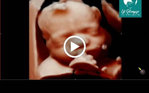 1st Glimpse 3D/4D Ultrasound image