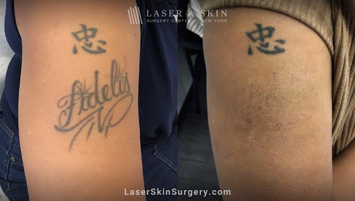 Explore stamp tattoo ideas, creative tattoo ideas in Southampton, available at Laser & Skin Surgery Center of New York - Southampton