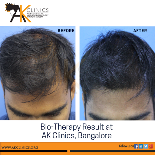 AK Clinics Hair Transplant Delhi - Best Hair Transplant Clinic