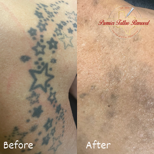 Explore lion king tattoo ideas, creative tattoo ideas in Mckinney, available at Premier Tattoo Removal