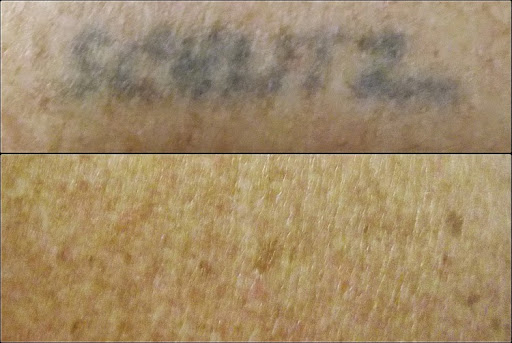 Explore dog paw tattoos ideas, creative tattoo ideas in Weatherford, available at Vanish Laser Tattoo Removal and Skin Aesthetics