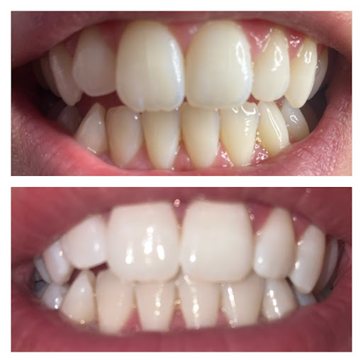 The Glow Bar - Cosmetic Teeth Whitening in Dublin 22, Co. Dublin (Baile Átha Cliath)