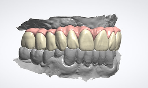 Curso de implantologia digital dental
