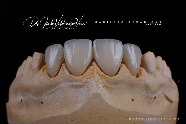 Estética Dental Manta - Dr. Joab Valdivieso Vera / Odontólogo - Manta