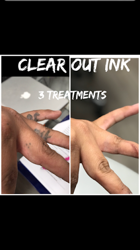 Explore blacked out tattoo ideas, creative tattoo ideas in Cookeville, available at Clear Out Ink Laser Tattoo Removal