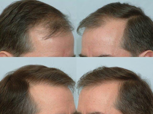 Anagen Hair Transplant Clinic