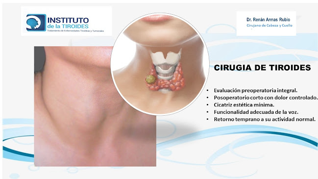 Instituto de la Tiroides - Dr. Renán Armas Rubio - Cirujano Especialista de Tiroides y Oncología Cabeza y Cuello - Ambato