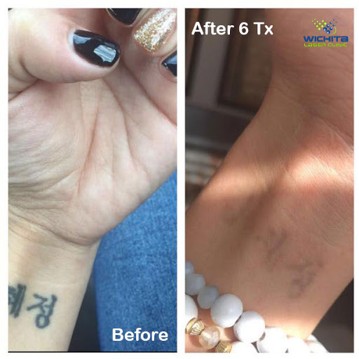 Explore womens thigh tattoo ideas, creative tattoo ideas in Wichita, available at Wichita Laser Clinic