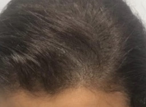 Explore forearm rose tattoo ideas, creative tattoo ideas in Minneapolis, available at Medical Tattoo & Cosmetic Centers of America